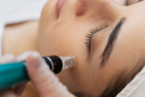 Skin Pen Técnica Microneedling, Centro Dermoestético Las Canteras, La Laguna