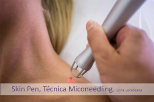 Skin Pen (Técnica-Miconeedling) Zona Localizada. Centro Dermoestético Las Canteras. La Laguna.
