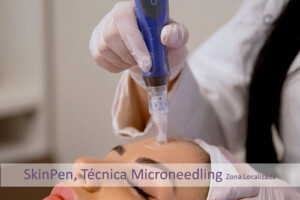 Skin Pen (Técnica-Miconeedling) Zona Localizada. Centro Dermoestético Las Canteras. La Laguna.